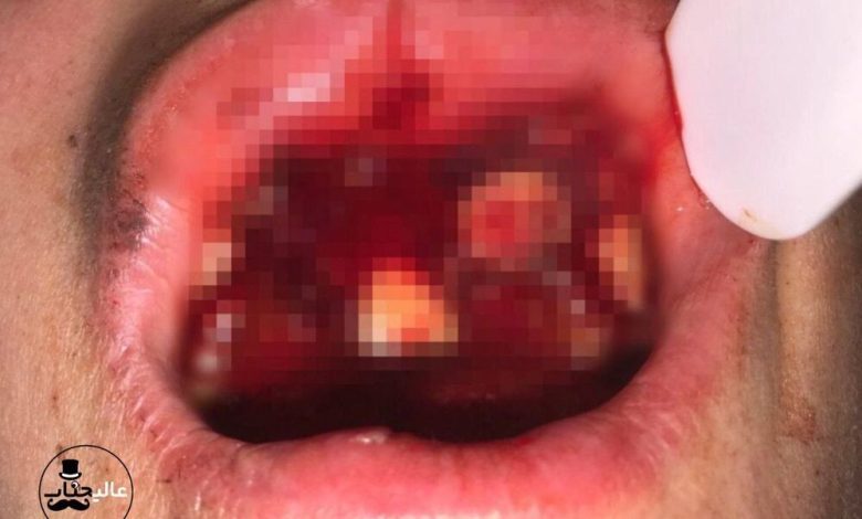 ترکیدن ویپ در دندان