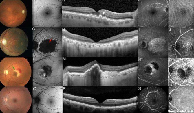 موفقیت دانشمندان ایرانی در راستای پیشگیری از نابینایی مبتلایان به عارضه ارثی شبکیه