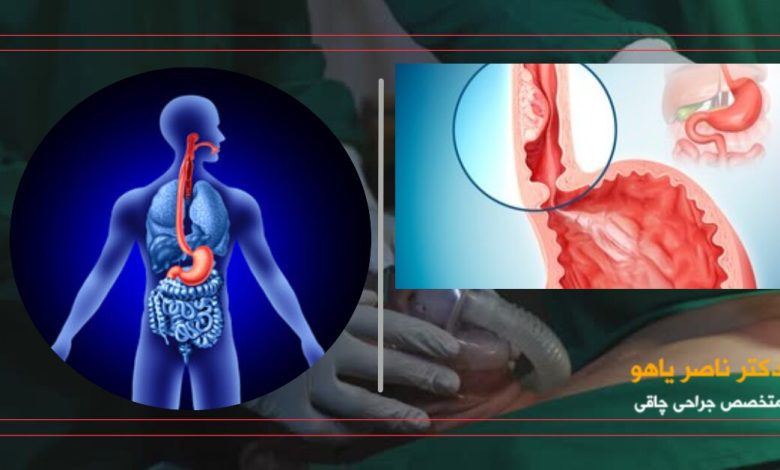 آیا عمل اسلیو معده باعث سرطان میشود