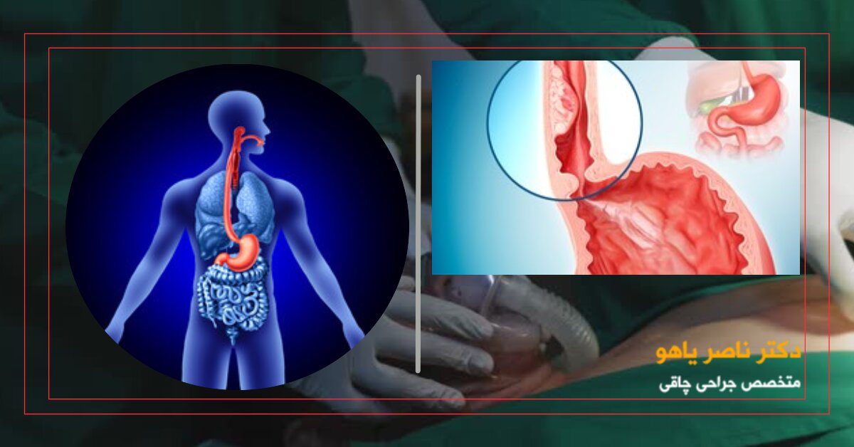 آیا عمل اسلیو معده باعث سرطان میشود