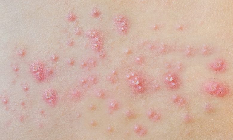 جوش باسن - علت جوش زدن باسن