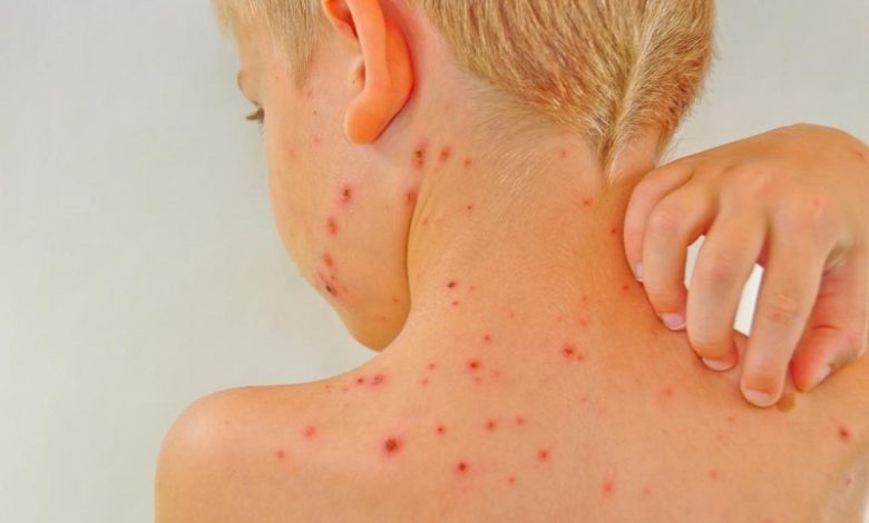 آبله مرغان در بزرگسالی