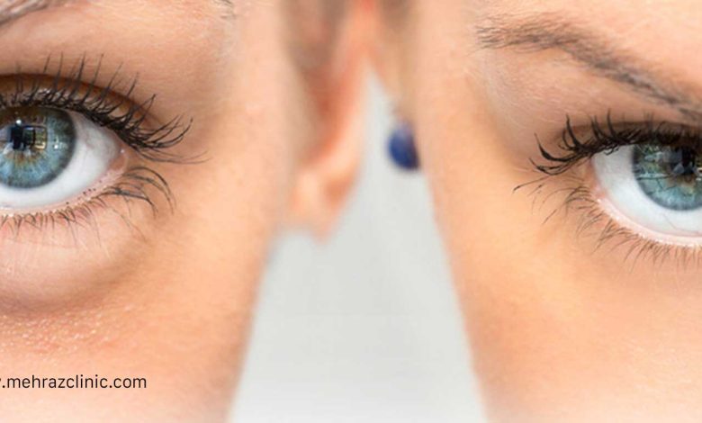 درمان پف زیر چشم با ماساژ