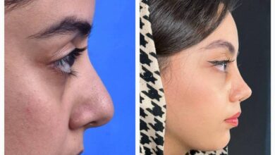 جراحی بینی در کرج