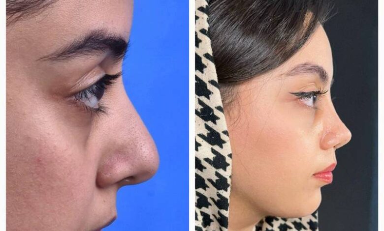جراحی بینی در کرج