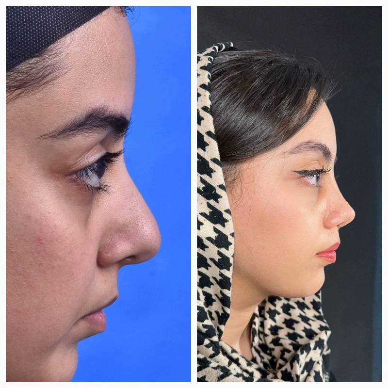 جراحی بینی در کرج