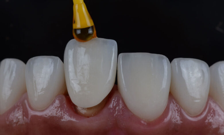 روکش دندان جلو بهتر است یا لمینت؟