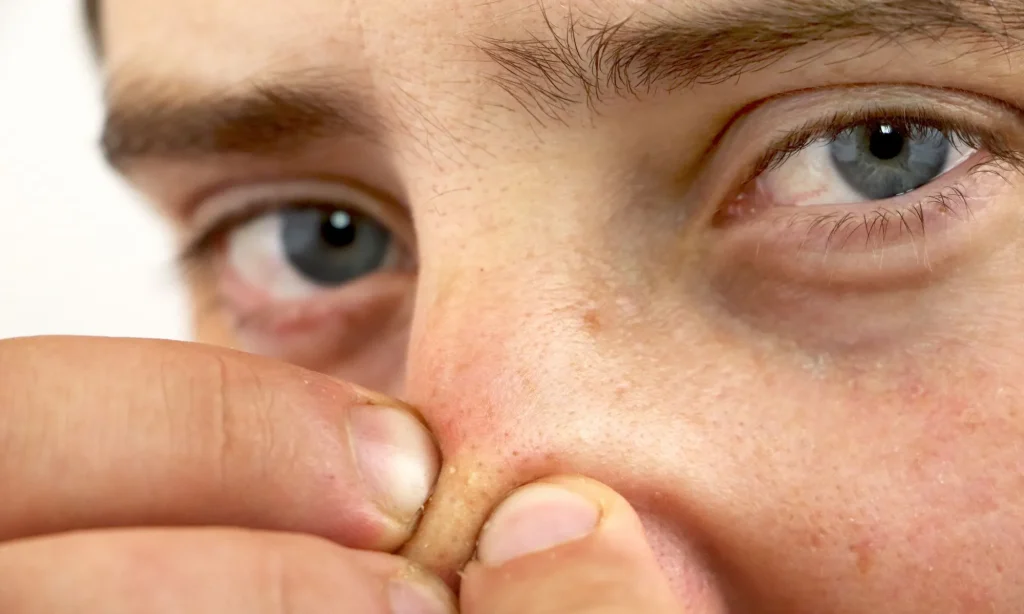 جوش روی بینی